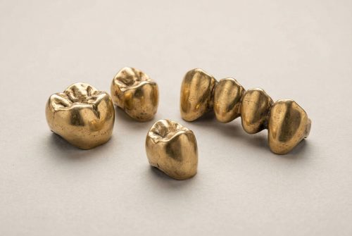 金歯買取のイメージ画像