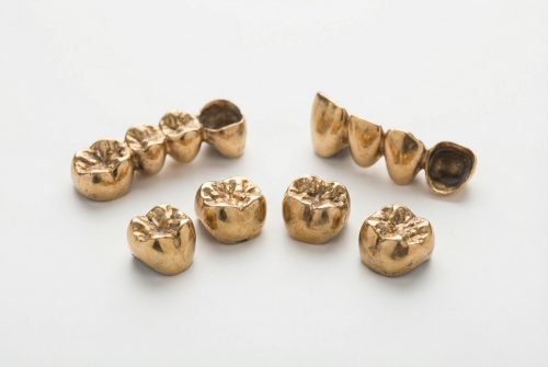 金の入れ歯は売れるの？金歯買取で高く売るコツと買取相場をわかりやすく解説