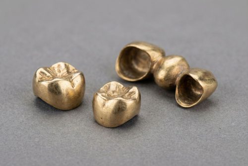 金の入れ歯をより高く・スムーズに売るためのコツ